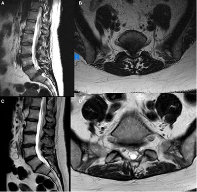 Minimally invasive discectomy versus open laminectomy and discectomy for the treatment of cauda equina syndrome: A preliminary study and case series